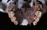 文件名稱:M1之上顎骨標本圖
